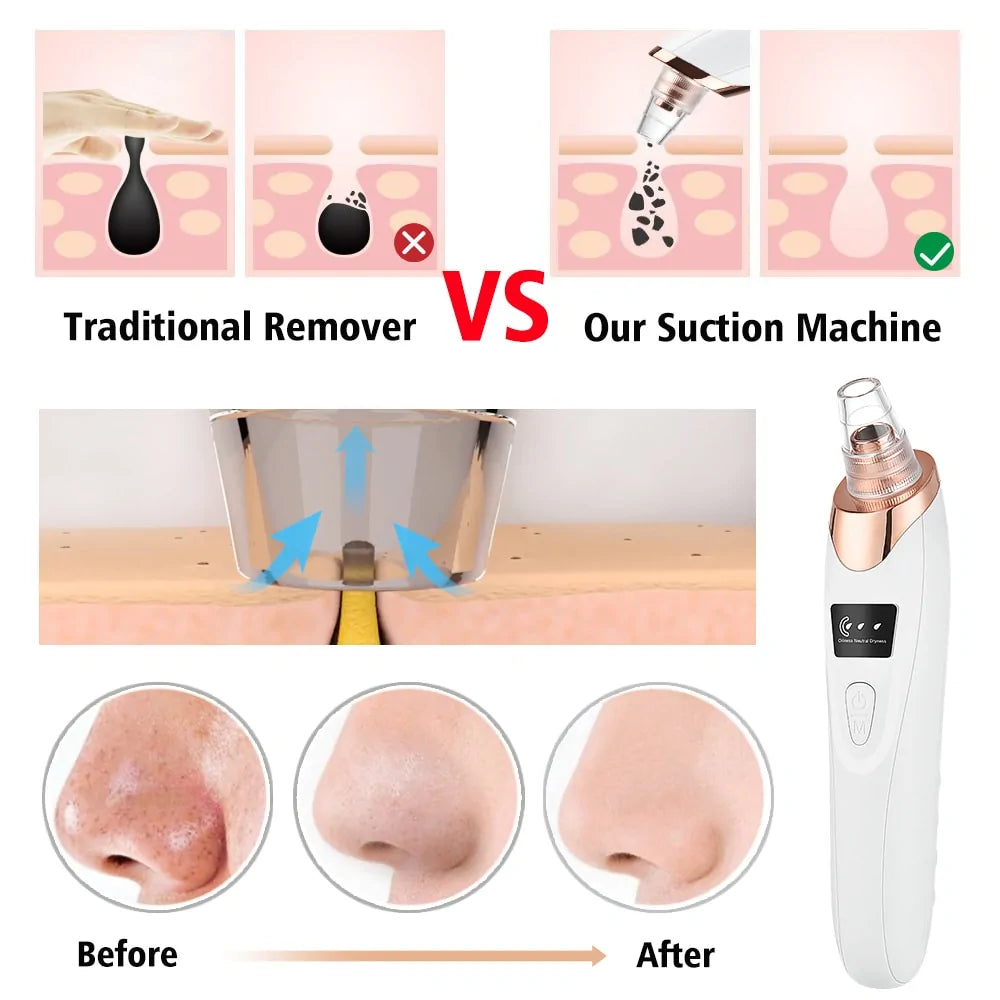 Orelle PorePro™ – Advanced Blackhead Vacuum